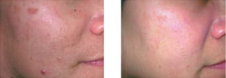 Media_Default_ImageGallerie__Elo__20Skin_20Rejuvenation__r_20ba1-e1557122806142