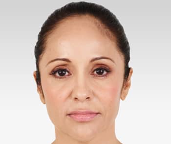 Media_Default_ImageGallerie__Juvederm_1juvderm_20after