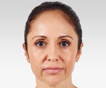 Media_Default_ImageGallerie__Juvederm_1juvederm_20before
