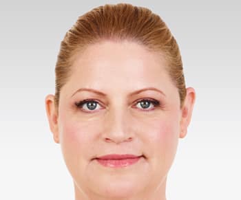 Media_Default_ImageGallerie__Juvederm_2juvederm_20after