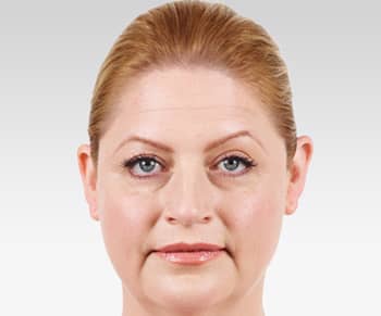 Media_Default_ImageGallerie__Juvederm_2juvederm_20before
