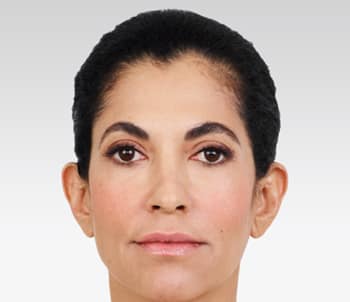 Media_Default_ImageGallerie__Juvederm_3juvederm_20after