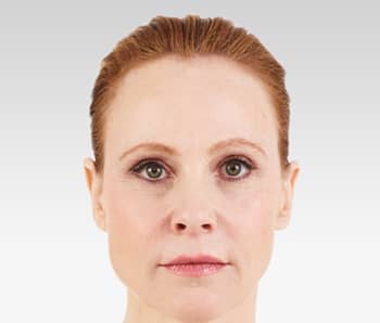 Media_Default_ImageGallerie__Juvederm_4juvederm_20after