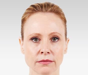 Media_Default_ImageGallerie__Juvederm_4juvederm_20before