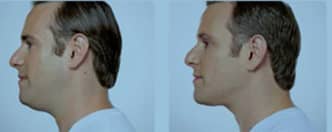 Media_Default_ImageGallerie__Kybella_Kybella_202-e1557122538715